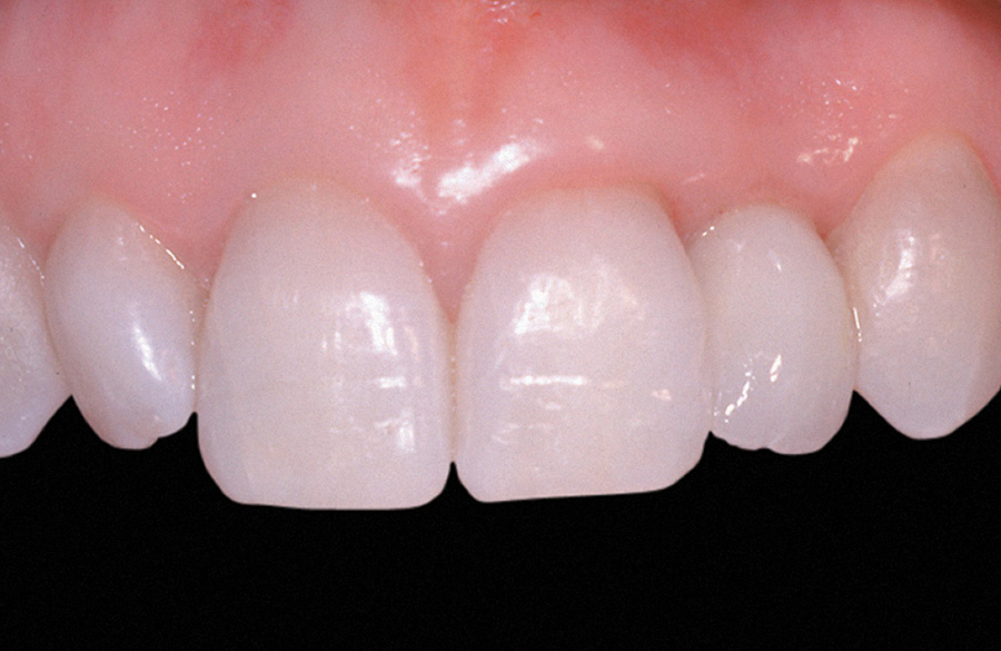 Zubni implanti posle intervencije