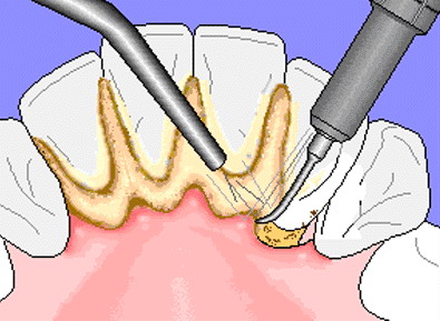Skidanje zubnog kamenca