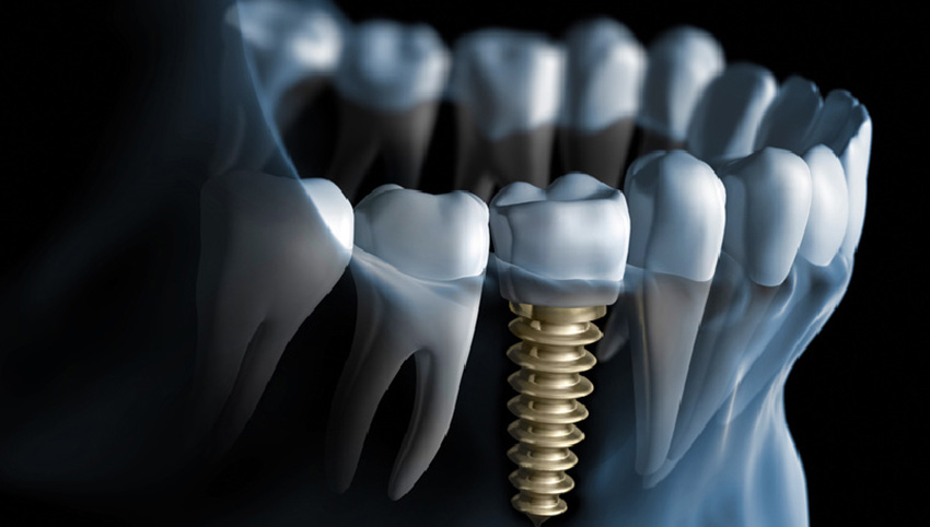 nadoknada izvadjenog zuba implant vilica