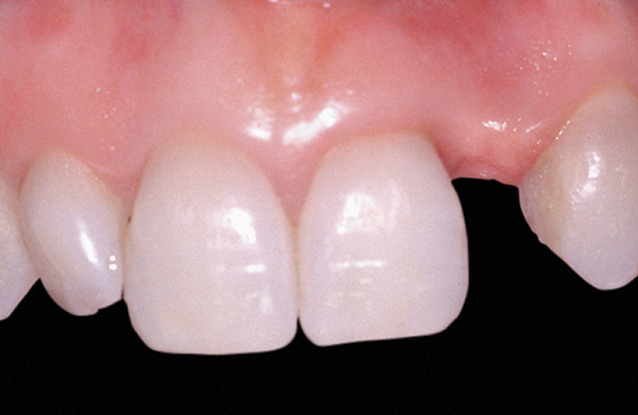 Zubni implanti pre intervencije